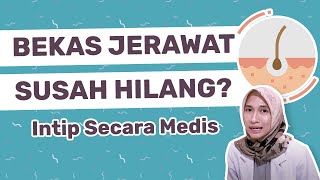 CARA MENGHILANGKAN BEKAS JERAWAT BOPENG  dr Vania Utami [upl. by Otineb]