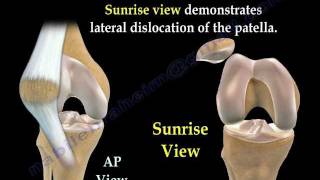 Patellar Dislocations  Everything You Need To Know  Dr Nabil Ebraheim [upl. by Leahcimdivad]