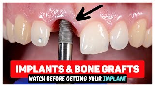 Dental Bone Grafts Explained [upl. by Arimlede]