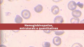 Hemoglobinopatias estruturais e quantitativas [upl. by Tallula]