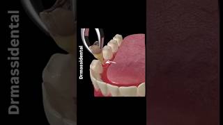 Tooth removal movement of teeth to the adjacent space [upl. by Deenya601]