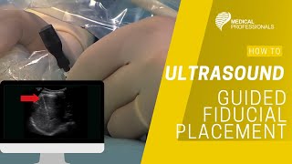 Ultrasound Guided Fiducial Placement for Stereotactic Radiotherapy [upl. by Aissenav671]