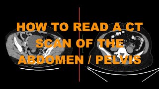 How to read a CT abdomen pelvis scan  introduction to abdominal imaging for junior doctors [upl. by Hannahs]