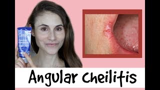 Angular cheilitis causes amp treatments a QampA with dermatologist Dr Dray [upl. by Fidelity]