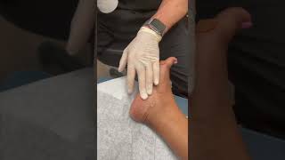 Cortisone Injection for Heel Pain Plantar Fasciitis [upl. by Yecal539]