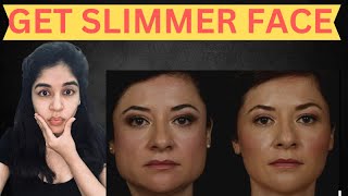 Get slimmer face with Botox  Dr Anvika 8287001211 [upl. by Kerril]