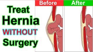 How to Cure Hernia Without Surgery  Hernia Treatment Natural Without Surgery [upl. by Odlauso]