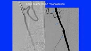 Options to Improve Endovascular Treatment of Claudication and CLI  UCSF Vascular Surgery Symposium [upl. by Adranoel]