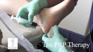 PRP Platelet Rich Plasma Therapy for Plantar Fasciitis Heel Pain [upl. by Peednam]