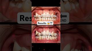 Braces process 3year braces orthodontist dentist niengrang [upl. by Nithsa]