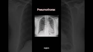 Diagnose Pneumothorax on chest Xray radiology cxr [upl. by Goldshell]