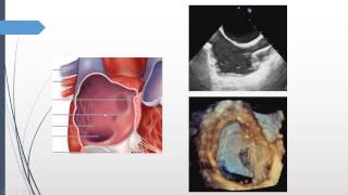 How to image the interatrial septum using 3DTEE quotRATLe90 maneuverquot [upl. by Srini]