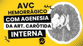 AVC Hemorrágico com Agenesia da Artéria Carótida Interna [upl. by Onateyac]