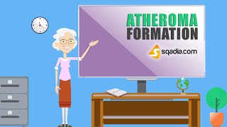 Atheroma Formation  Pathology Animation Video  Medical Online Education  VLearning™ [upl. by Einahpit]