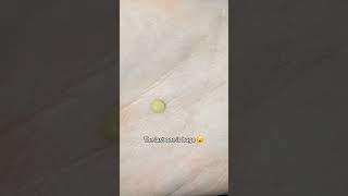 Tonsil stones cause bad breath satisfying shorts fyp trending sorotan mouth tonsilstones [upl. by Warren893]