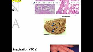 RS pathology 5 restrictive lung diseases [upl. by Ihcehcu]