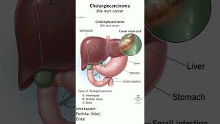 Cholangiocarcinoma shorts [upl. by Narf477]