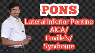 Pons Part  6 Lateral inferior pontine syndrome AICA syndrome Fovilles syndrome [upl. by Manvell]