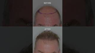 Restoring the frontal forelock  Anthony Bared MD FACS  Miami FL [upl. by Lledniuq]