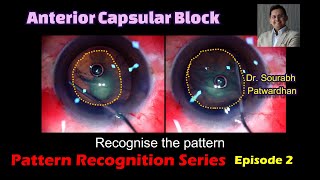 257 Anterior capsular block pattern recognition to avoid hydro rupture of PC Dr Sourabh Patwardhan [upl. by Adnwahsor]