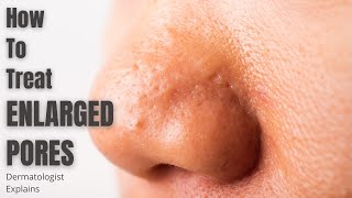 Enlarged Pores  How to effectively treat [upl. by Annayd]