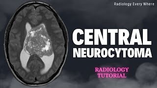 Central Neurocytoma Radiology Tutorials [upl. by Cirdek]