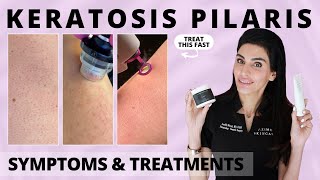 Keratosis Pilaris Causes Symptoms amp Treatments from a Dermatologist keratosispilaris chickenskin [upl. by Pollie]