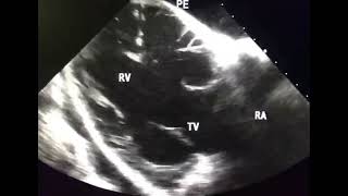 Torrential Tricuspid Regurgitation to drahmadmirdamadisiQPVCZhfjeWcSAAUc [upl. by Aibar]