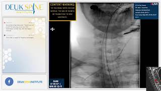 Watch Live Back Treatment Deuk Plasma Rhizotomy DPR  Cervical  RT C5T1 [upl. by Merete]