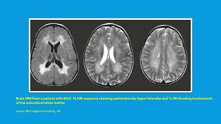 Neurology Quiz 103 Metachromatic leukodystrophy MLD [upl. by Ardyce]