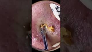 Ultimate Blackhead Removal amp Pimple Popping 🔴 70 [upl. by Tayler]