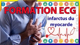 ECG de linfarctus du myocarde [upl. by Anytsirk783]