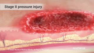 Pressure Injuries [upl. by Leibrag]