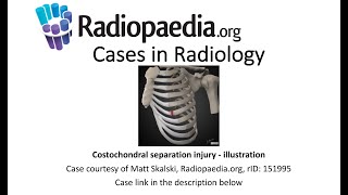 Costochondral separation injury  illustration Radiopaediaorg Cases in Radiology [upl. by Nyrahs]