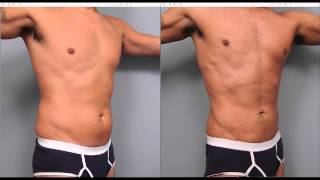 The Benefits of Liposuction for Men  Dr Sterry Explains [upl. by Roel]