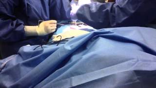 Part 1 of Bowel Resection Surgical Technology [upl. by Haissem44]