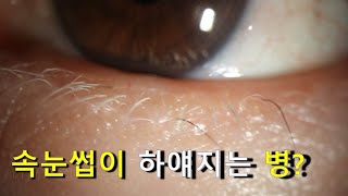 한쪽 속눈썹만 하얘지는 병 백모증 poliosis [upl. by Ecirahc]