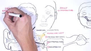 Acute Otitis Media Causes Pathophysiology signs and symptoms treatment and complications [upl. by Caty]