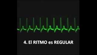 TAQUICARDIA SUPRAVENTRICULAR PAROXÍSTICA ANÁLISIS [upl. by Nomed]