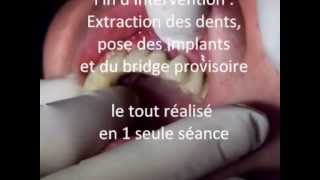 Mise en charge immédiate implants et bridge en 1 seule scéance protocole POSITDENTAL 002 [upl. by Polash304]