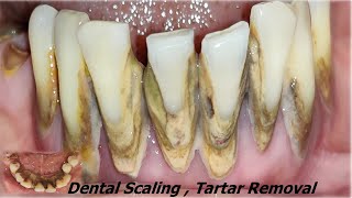 Tartar Removal in Lower Teeth I ScalingTeeth whitening I पत्थर के जैसे पायरिया का इलाजI Dr Ram MDS [upl. by Lanta]