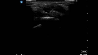 Wrist Ultrasound Arthrocentesis in Short Axis [upl. by Otcefrep]