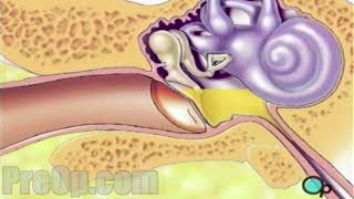 Myringotomy Insertion of Tube Surgery PreOp® Patient Education [upl. by Hendrik]