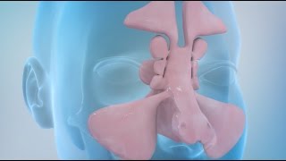 Sinusitis and Sinus Surgery Explained Balloon Sinuplasty and Endoscopic Sinus Surgery [upl. by Port222]