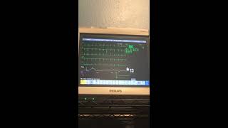 Philips IntelliVue MP70 ECG with extrasystoles [upl. by Shaya958]