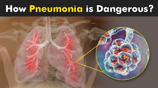 What Happens in Pneumonia  Symptoms Causes and Treatment 3D Animattion [upl. by Mixam]