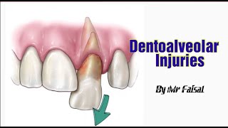 Dentoalveolar Injuries Part1 [upl. by Sidell288]