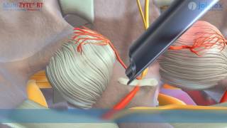 Animation MultiZYTE RT – Facet Denervation [upl. by Annodas]