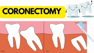 Coronectomy  wisdom tooth  Very easy to learn  Dental dream [upl. by Zoie611]