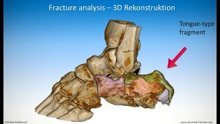 Technique of minimalinvasive treatment on a calcaneal fracture  Tonguetype [upl. by Ianej372]